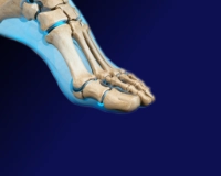 Acortamiento de dedos